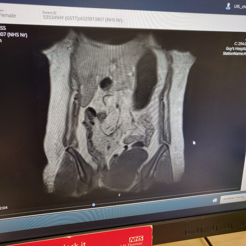 My peritoneal inclusion cyst - Pelican Healthcare